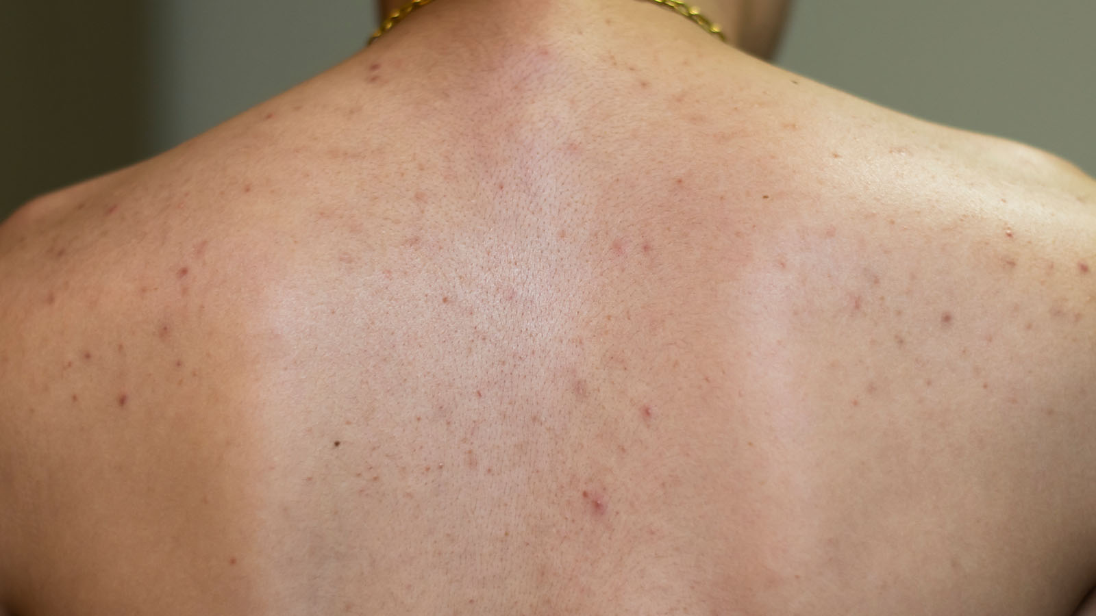 Acne Care Body