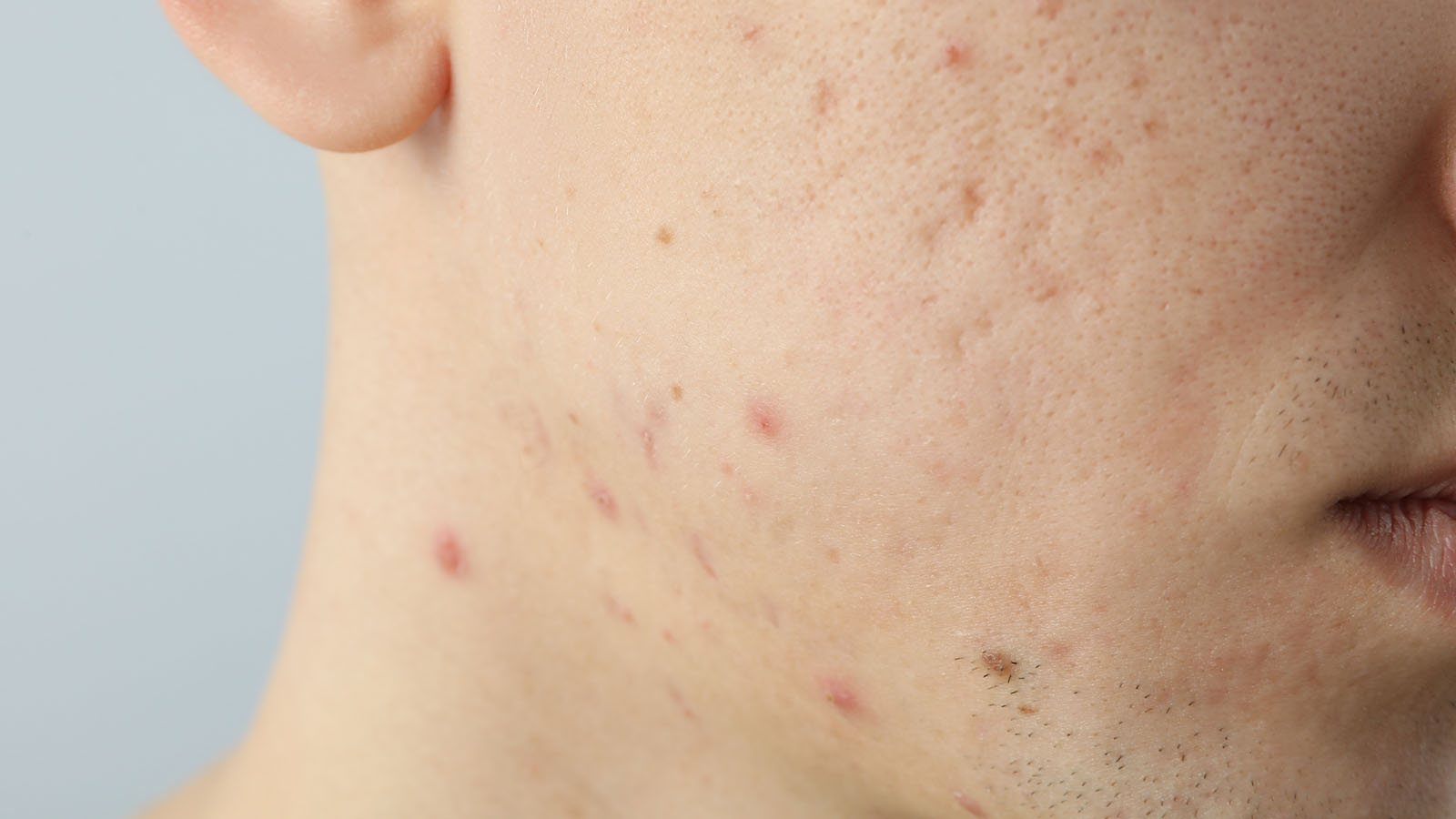 Acne Care